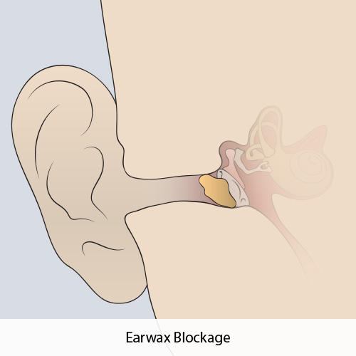 Benefits & Risks of Ear Plugs (Inc. Ear Wax Issues)